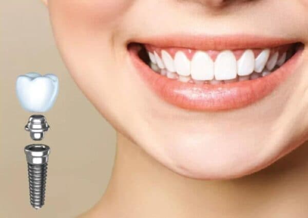 Bảng giá trồng răng Implant là điều được nhiều khách hàng quan tâm