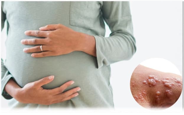 bầu bị đậu mùa khỉ uống thuốc gì