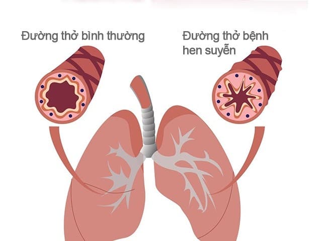 Triệu chứng bệnh hen suyễn hay hen phế quản