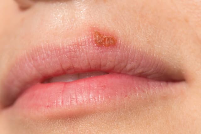Giải đáp chi tiết: Bệnh herpes kiêng ăn gì?