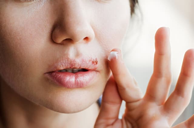 Bệnh herpes môi kiêng ăn gì để hạn chế viêm loét