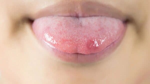 bệnh herpes ở lưỡi