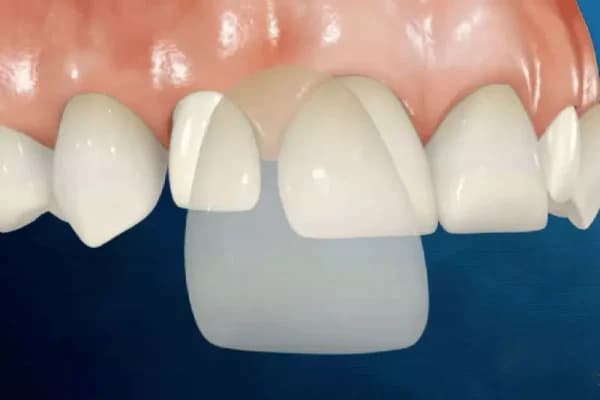 bọc răng sứ 1 cái