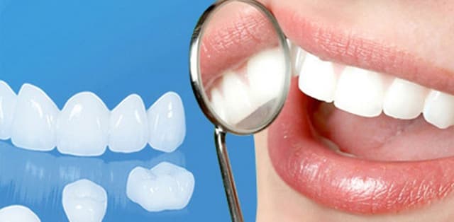 Giải đáp thắc mắc: bọc răng sứ 1 chiếc được không