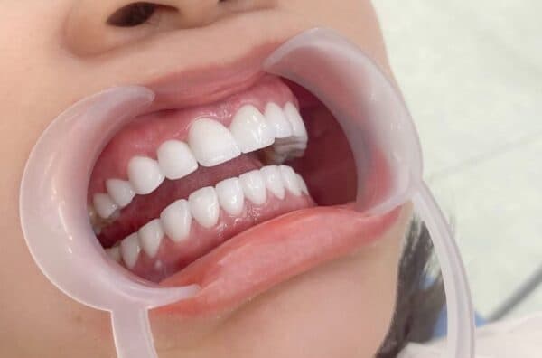 Những trường hợp cần bọc răng sứ cả hàm để cải thiện