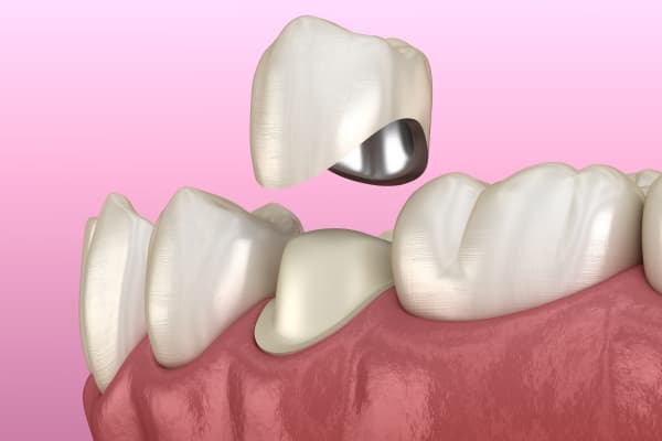 Nhiều người cảm thấy băn khoăn không biết bọc răng sứ có bền không