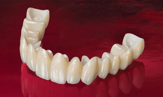 Bọc răng sứ của Đức và các loại phổ biến