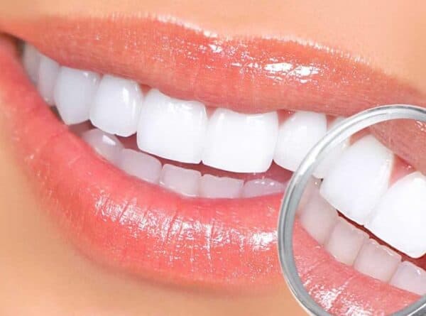 5 điểm nổi bật của bọc răng sứ Diamond