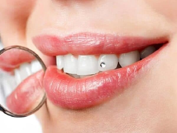 Tìm hiểu khái niệm và nguồn gốc của bọc răng sứ Diamond