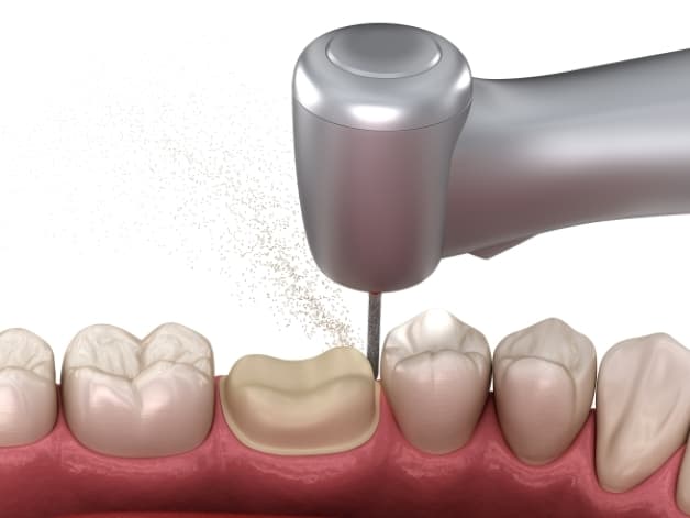 bọc răng sứ có đau không