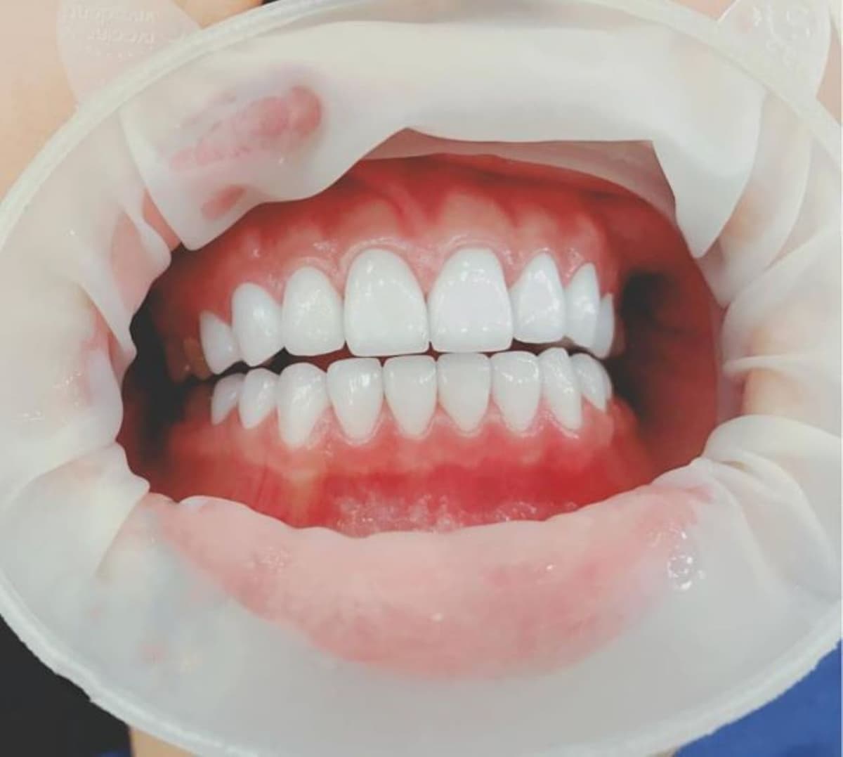 Giải đáp vấn đề bọc răng sứ giữ được bao lâu