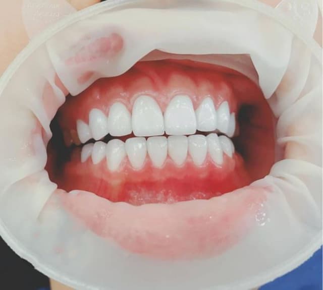 Giải đáp vấn đề bọc răng sứ giữ được bao lâu