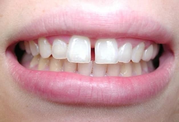 bọc răng sứ hai răng cửa