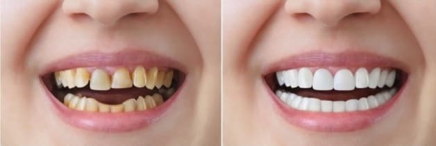 bọc răng sứ hàm dưới