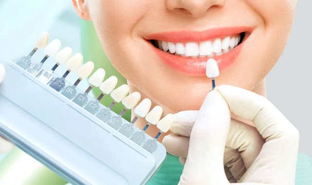 Những điều cần lưu ý khi thực hiện bọc răng sứ hàm trên