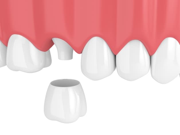 bọc răng sứ hàm trên