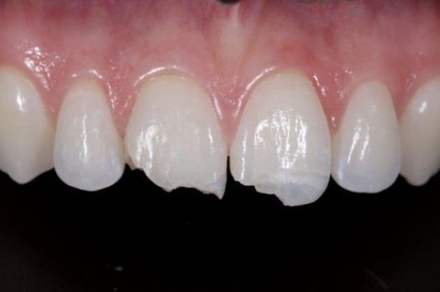 bọc răng sứ hàm trên