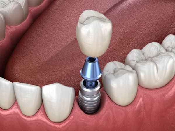 Tìm hiểu bọc răng sứ Implant là gì?