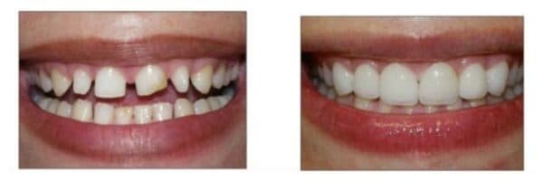 Giải pháp bọc răng sứ kim loại hiện được sử dụng rất nhiều