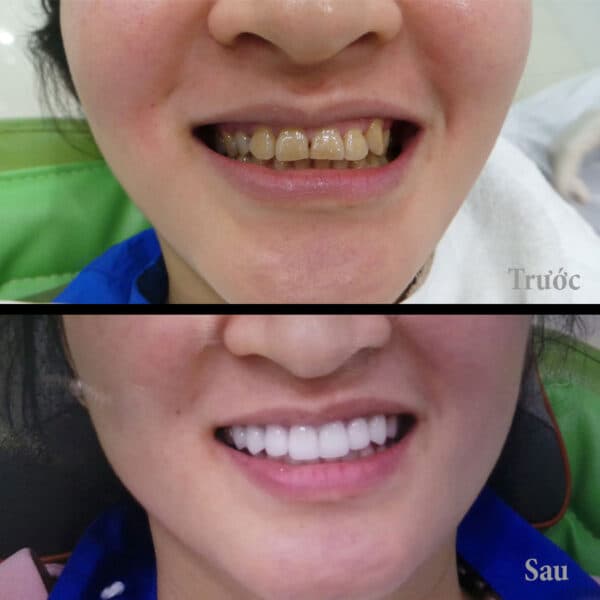 Các loại răng sứ Mỹ và sự đánh giá chi tiết