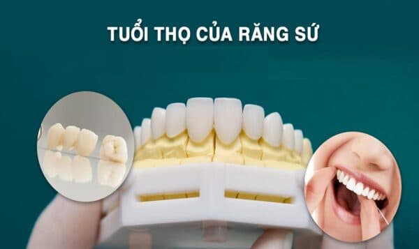 Bọc răng sứ sử dụng được bao lâu với từng loại vật liệu?