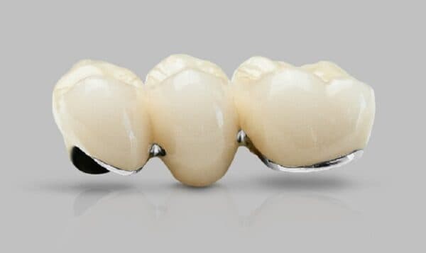 Giải đáp chi tiết bọc răng sứ titan giá bao nhiêu và loại nào tốt-1