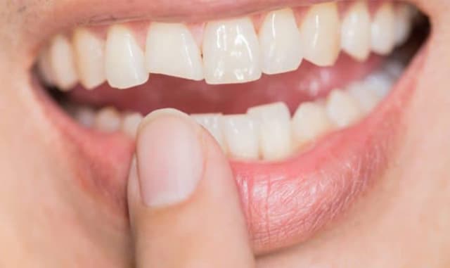 Bọc răng sứ 2 răng cửa giá bao nhiêu và độ hiệu quả