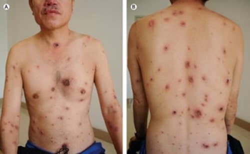 Khi bị giang mai, người bệnh sẽ nổi lên các nốt đỏ trên người, ngứa ngáy khó chịu