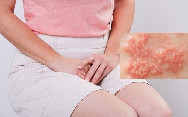 Sùi mào gà có thể gặp phải ở cả nam và nữ