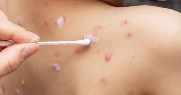 cách chữa bệnh thủy đậu nhanh nhất cho bé