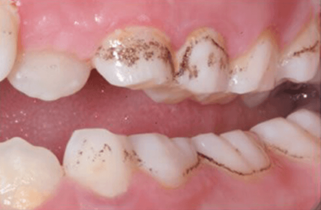 cách trị sâu răng bị đen như thế nào