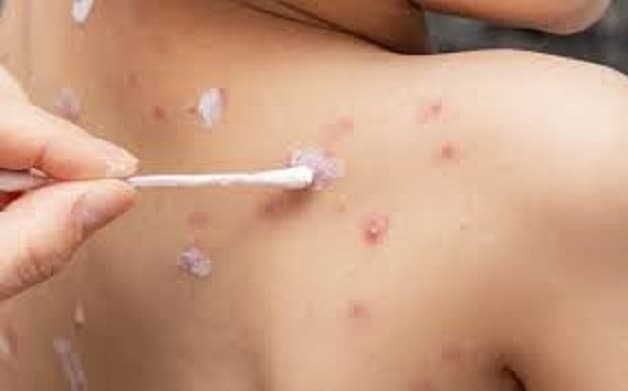 Cách trị bệnh thủy đậu nhanh nhất