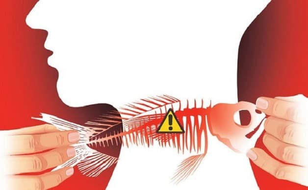 mô tả về cách trị hóc xương cá lâu ngày