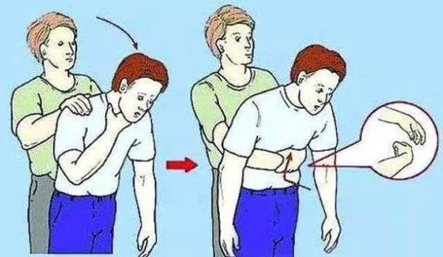 Cách xử lý khi bạn bị hóc dị vật đường thở bằng Heimlich