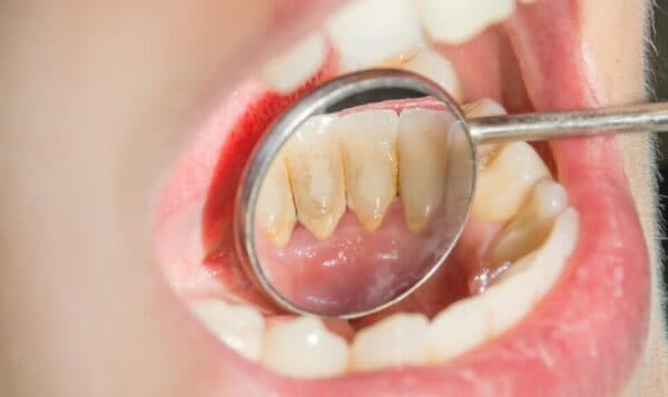 Cao răng độ 1 là gì?