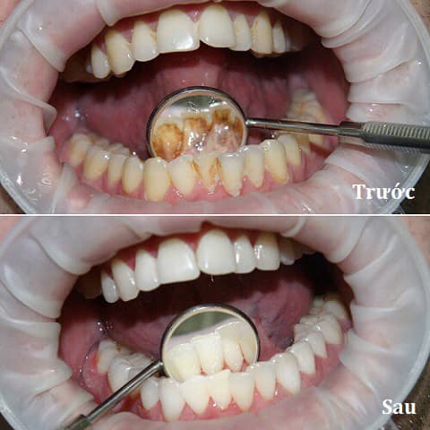 Cách loại bỏ cao răng độ 3 là gì?
