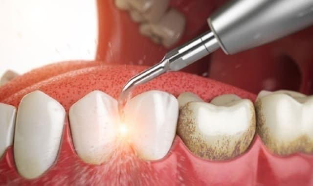 Phương pháp xử lý cao răng sữa cho trẻ hiệu quả