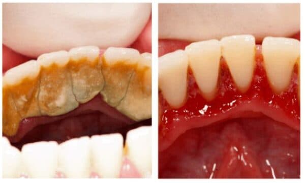 Phân loại 3 cấp độ của cao răng