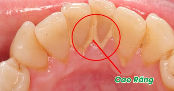 cạo vôi răng tại nhà