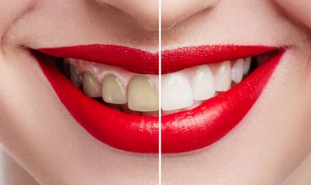 cạo vôi tẩy trắng răng