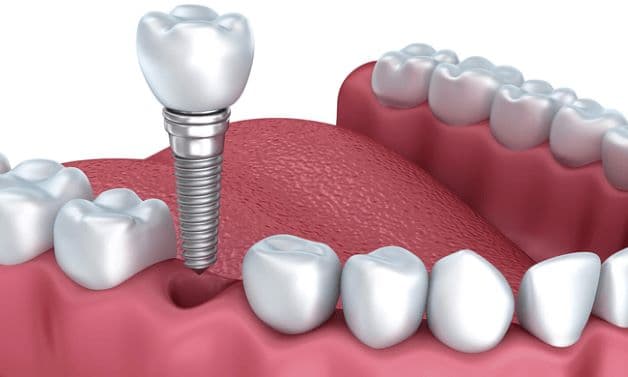 Cấy ghép Implant là phương pháp phục hình răng khá phổ biến hiện nay