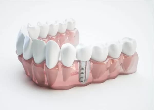 Vẫn có những nơi làm Implant giá thấp, nhưng khách hàng cần tìm hiểu thật kỹ