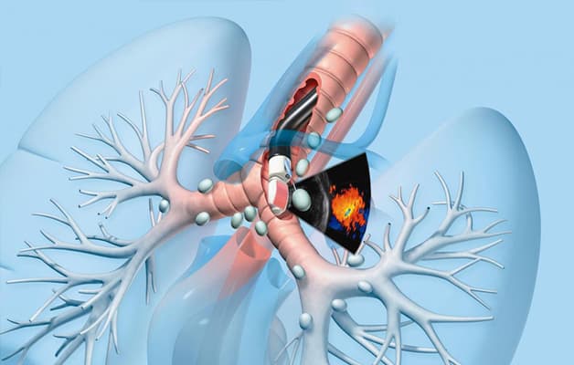Nội soi phế quản là phương pháp chẩn đoán viêm phổi hiệu quả cao.