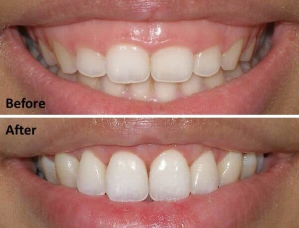 Phẫu thuật điều chỉnh cơ môi