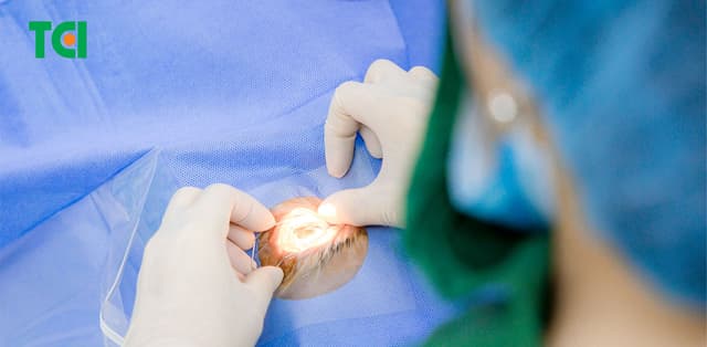 Tìm hiểu chi phí mổ mộng mắt và an tâm điều trị
