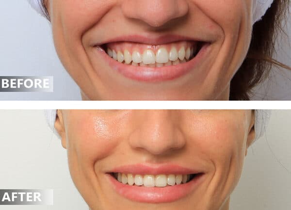 Nguyên nhân nào khiến cười bị hở lợi?