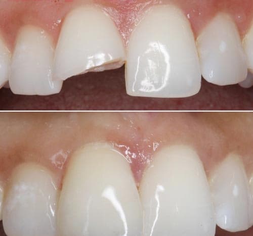 chi phí trám răng bị mẻ