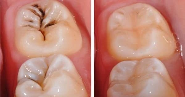 Chọn lựa phương pháp xử trí răng sâu như thế nào phụ thuộc vào thăm khám của bác sĩ