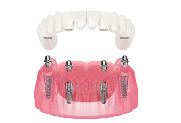 tìm lời giải đáp chi phí trồng răng Implant