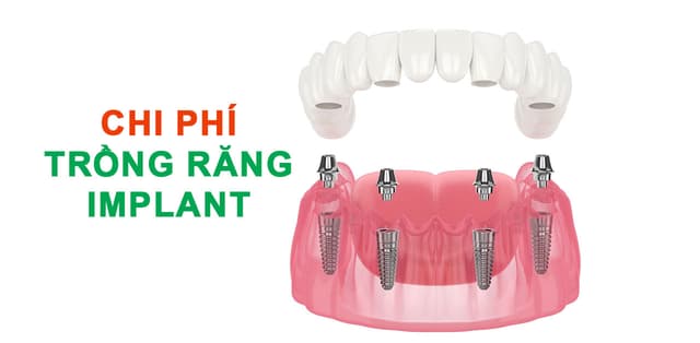 Giải quyết lo lắng trước chi phí trồng răng Implant